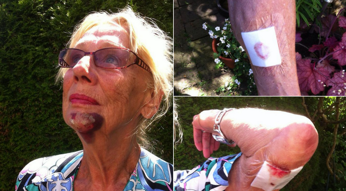 Ulla, 72, attackerades av grannens hund